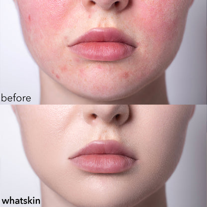 whatskin™ exosome - goodbye damaged skin!